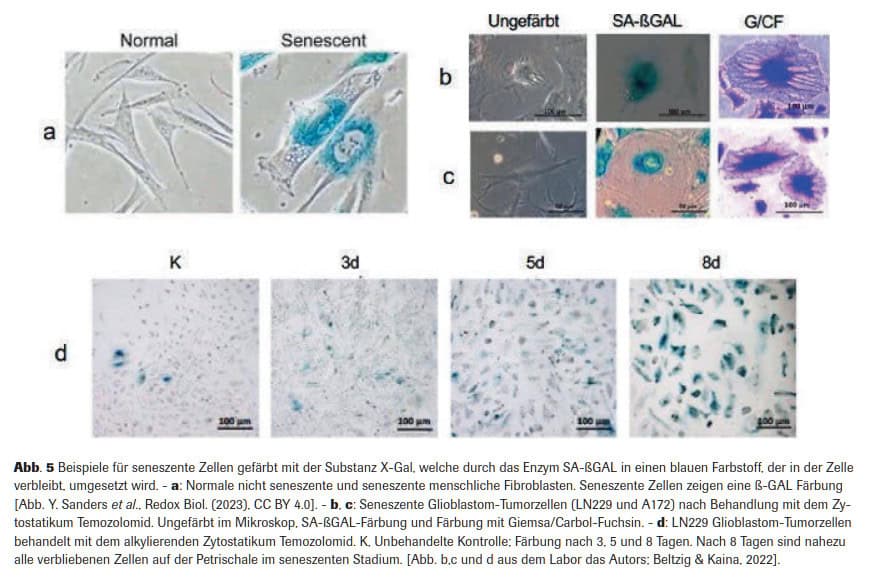 Abb. 5 Beispiele für seneszente Zellen gefärbt mit der Substanz X-Gal, welche durch das Enzym SA-ßGAL in einen blauen Farbstoff, der in der Zelle verbleibt, umgesetzt wird. - a: Normale nicht seneszente und seneszente menschliche Fibroblasten. Seneszente Zellen zeigen eine ß-GAL Färbung [Abb. Y. Sanders et al., Redox Biol. (2023), CC BY 4.0]. - b, c: Seneszente Glioblastom-Tumorzellen (LN229 und A172) nach Behandlung mit dem Zy- tostatikum Temozolomid. Ungefärbt im Mikroskop, SA-ßGAL-Färbung und Färbung mit Giemsa/Carbol-Fuchsin. - d: LN229 Glioblastom-Tumorzellen behandelt mit dem alkylierenden Zytostatikum Temozolomid. K, Unbehandelte Kontrolle; Färbung nach 3, 5 und 8 Tagen. Nach 8 Tagen sind nahezu alle verbliebenen Zellen auf der Petrischale im seneszenten Stadium. [Abb. b,c und d aus dem Labor das Autors; Beltzig & Kaina, 2022].