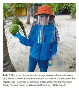 Abb. 8 Menschen, die an Xeroderma pigmentosum (Mondscheinkinder) leiden, m&uuml;ssen Sonnenlicht meiden, um sich vor Sonnenbrand, Keratosen und Hautkrebs zu sch&uuml;tzen. [Foto: Xeroderma Pigmentosum Family Support Group via Wikimedia Commons, CC BY-SA 4.0]