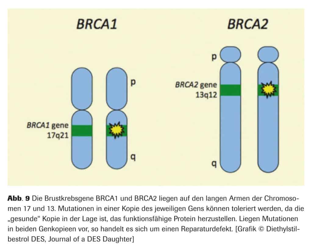 Abb. 9 Die Brustkrebsgene BRCA1 und BRCA2 liegen auf den langen Armen der Chromosomen 17 und 13. Mutationen in einer Kopie des jeweiligen Gens k&ouml;nnen toleriert werden, da die &bdquo;gesunde&ldquo; Kopie in der Lage ist, das funktionsf&auml;hige Protein herzustellen. Liegen Mutationen in beiden Genkopieen vor, so handelt es sich um einen Reparaturdefekt. [Grafik &copy; Diethylstilbestrol DES, Journal of a DES Daughter]